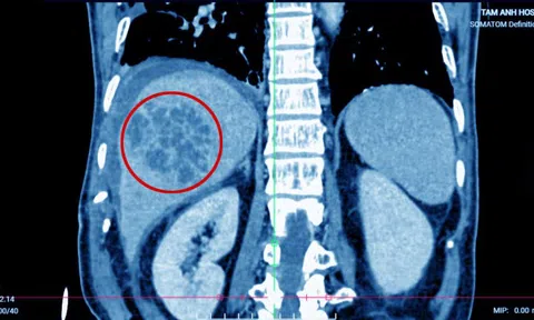 Sán lá gan nhỏ bội nhiễm E.coli tạo ổ áp xe trong gan