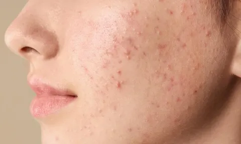 Hà Nội: Thiếu nữ phải thở máy, tổn thương não vì sốc nhiễm khuẩn do... mụn