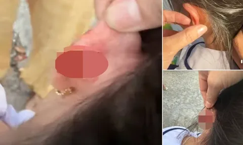 Xác minh vụ giáo viên tiểu học véo tai học sinh lớp 1 chảy máu