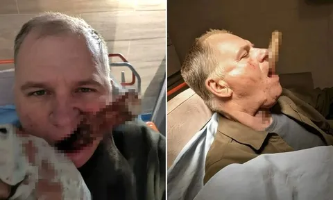 Trượt chân khi lao động, người đàn ông gặp tai nạn nghiêm trọng