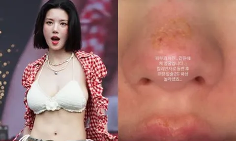 Nữ ca sĩ 31 tuổi bị bỏng nặng sau chuyến leo núi