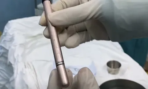 Thiếu nữ dùng cây bút gãi ngứa vùng kín rồi bị mắc kẹt trong bàng quang