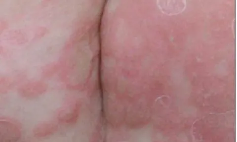 Bé trai 3 tuổi bị giang mai bẩm sinh dù không có triệu chứng