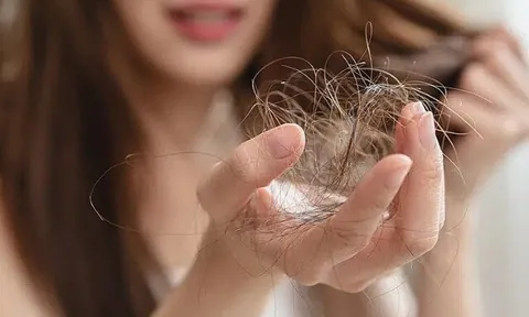 4 nguyên nhân phổ biến khiến vuốt nhẹ tóc cũng rụng cả nắm