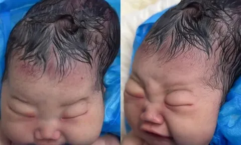 Bé gái sơ sinh chào đời với cái đầu nhọn, bố sợ hãi không nhận con, bác sĩ báo tin vui
