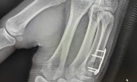 Nam sinh gãy xương bàn tay sau cú đấm boxing