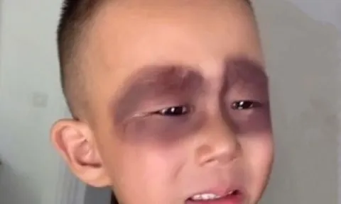 Bé trai 5 tuổi ngủ dậy khóc thét vì mặt bỗng bầm tím, nguyên nhân từ thói quen tai hại mỗi ngày