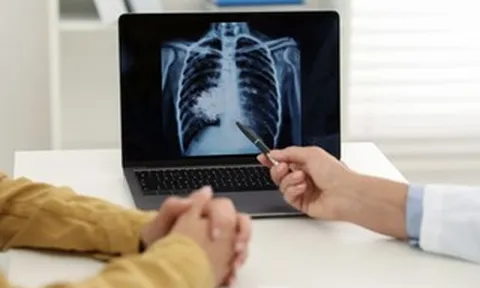 TPHCM sẽ triển khai chiến dịch 100 ngày sàng lọc lao chủ động trong cộng đồng