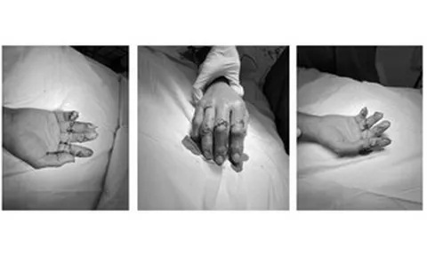 Xuyên đêm nối lại 4 ngón tay đứt rời cho người đàn ông bị tai nạn máy cắt