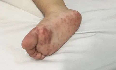 Dịch tay chân miệng “nóng” trở lại, trẻ nhỏ đối mặt nguy cơ biến chứng nặng