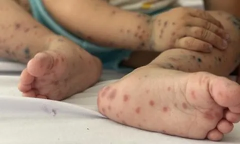 Tay chân miệng tăng mạnh, trẻ em chiếm hơn 99% ca mắc