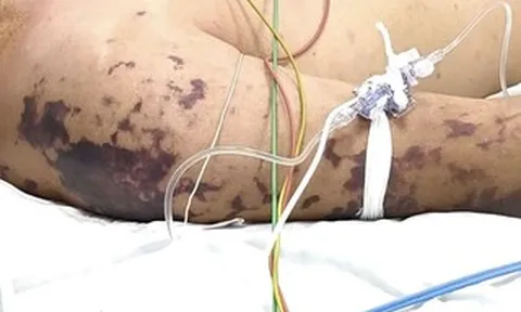 4 ca tử vong do não mô cầu, Bộ Y tế cảnh báo nguy cơ