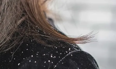 Chuyên gia cảnh báo: 50% dân số từng bị gàu nhưng điều trị chưa đúng