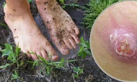 Hiểu đúng về bệnh do "vi khuẩn ăn thịt người"