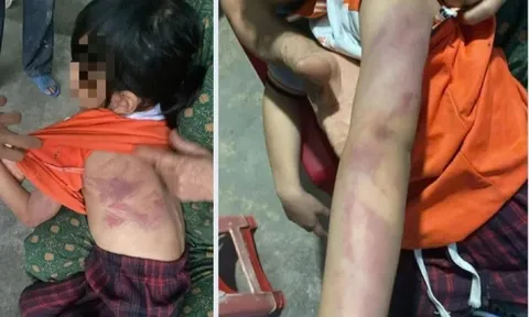 Bé gái lớp 2 bị bạn dùng thước đánh bầm tím người trong giờ ra chơi