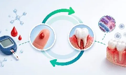58% người mắc tiểu đường bị bệnh nha chu: Đừng xem nhẹ dấu hiệu chảy máu chân răng