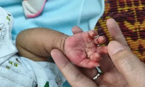 Xuất hiện dấu hiệu lạ ở da, bé 2 tháng tuổi mắc bệnh ít ai ngờ
