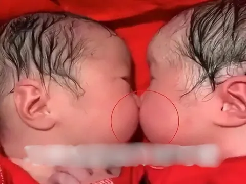 Cặp sinh đôi bám chặt lấy nhau khi mới chào đời, y tá không thể tách rời mà phải thốt lên: “Thật hiếm gặp”
