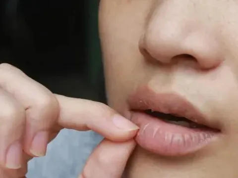 'Nghiện' son dưỡng khi môi khô nứt, nhưng càng thoa lại càng khô