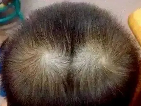 Người có hai xoáy tóc thường thông minh hơn?