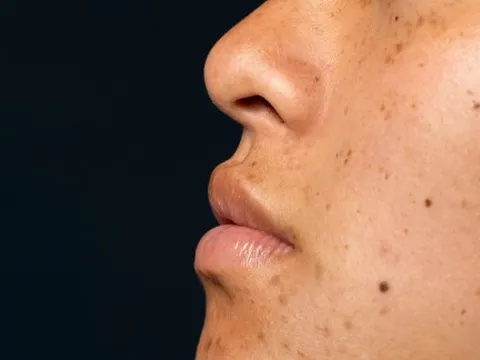 Tại sao mụn không nặn vẫn để lại vết thâm?