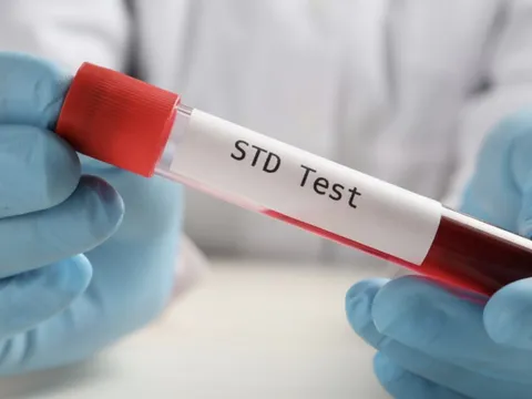 1 bệnh viện ở TP HCM ghi nhận 1 năm hơn 38.000 ca sùi mào gà