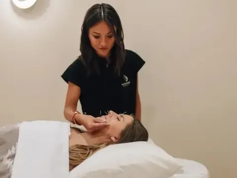 Châm cứu để căng da ngày càng được ưa chuộng