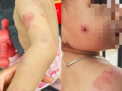 Bé gái hơn 2 tuổi chi chít vết cắn trên người sau giờ học