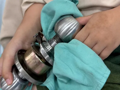 Bé trai vào viện cấp cứu cùng ổ khoa dính chặt ngón tay