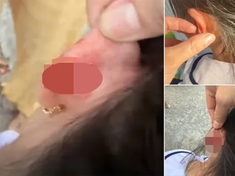 Xác minh vụ giáo viên tiểu học véo tai học sinh lớp 1 chảy máu