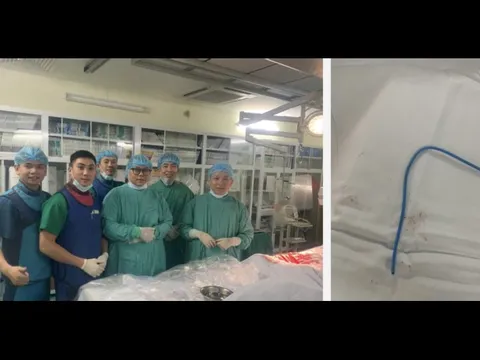 Ống thông truyền hóa chất bị bỏ quên suốt 3 năm, đứt trôi vào tim người phụ nữ