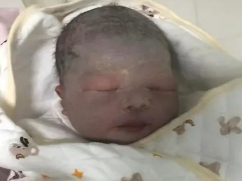 Bé sơ sinh chào đời da tím tái như quả cà, bố sợ không dám đến gần, 3 tháng sau diện mạo gây ngỡ ngàng