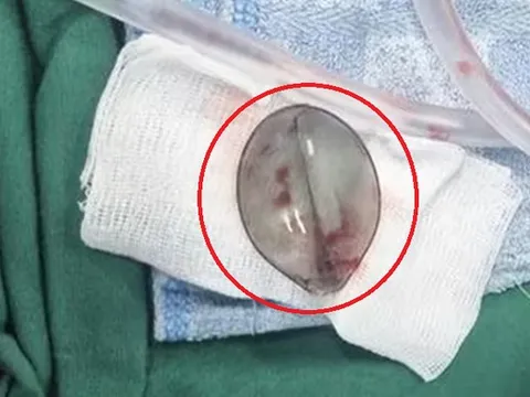 Bé 4 tuổi nôn ra máu, bác sĩ phát hiện thứ "đáng sợ" bên trong