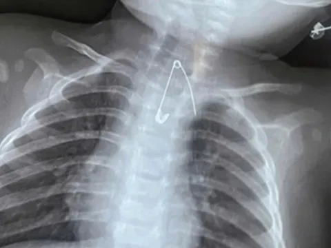 Bé 7 tháng tuổi khò khè kéo dài, bác sĩ phát hiện bí mật "đáng sợ"