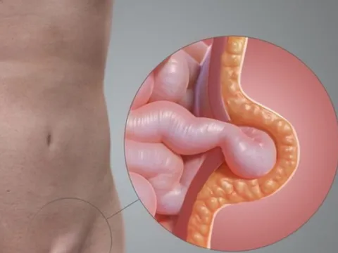 Bé gái quấy khóc vì khối phồng bẹn: Cảnh báo bố mẹ đừng chủ quan