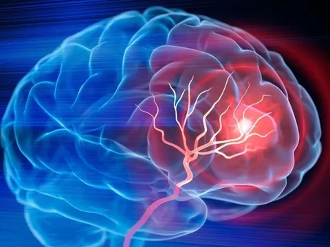 Mỹ phát triển phương pháp trị đột quỵ mới, chỉ cần 1 lần truyền dịch