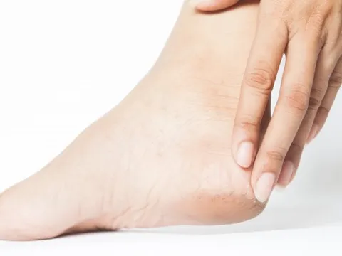 5 cách đơn giản giúp gót chân mềm mịn, tạm biệt nứt nẻ