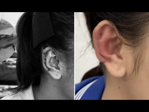 Tái tạo vành tai, trả lại dung mạo cho người phụ nữ trẻ bị tai nạn giao thông