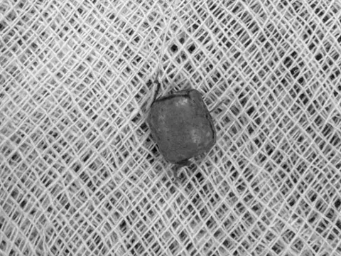 Bé 10 tuổi ù tai kéo dài, bác sĩ lấy ra thứ "đáng sợ" bên trong