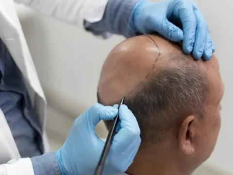 Nam giới cần biết gì trước khi quyết định cấy tóc vì hói?