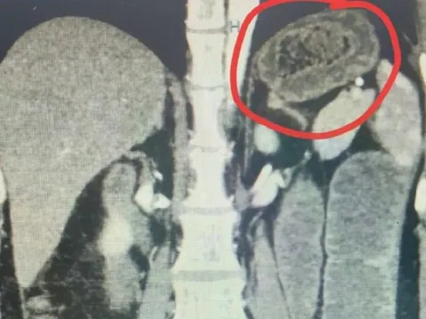 Người phụ nữ bụng "cứng như đá", bác sĩ sốc khi phát hiện bí mật "đáng sợ"