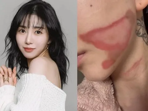 Gương mặt nữ ca sĩ 33 tuổi bị bỏng nghiêm trọng sau thẩm mỹ