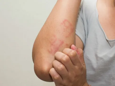 Ngứa không dứt, người phụ nữ 37 tuổi phát hiện cơ thể nhiễm tới 5 loại ký sinh trùng