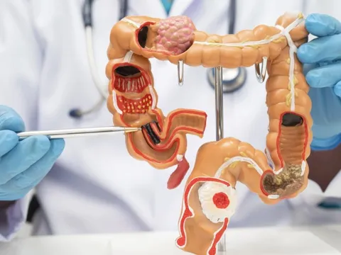 Đau bụng kéo dài, cụ bà 72 tuổi nhập viện trong tình trạng viêm phúc mạc toàn thể