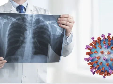 Viêm hô hấp cấp rình rập ngày Tết