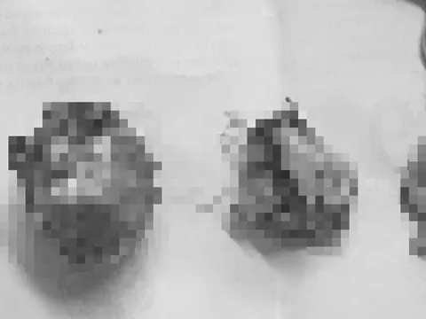 Người phụ nữ 66 tuổi đau bụng kéo dài, bác sĩ gắp ra thứ "đáng sợ"