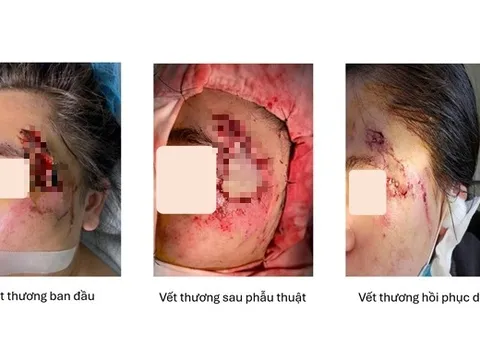Ghép da thành công cho cô gái bị hoại tử vùng mặt sau tai nạn giao thông