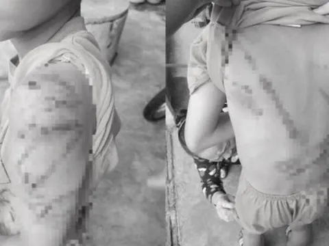 Học sinh lớp 4 ở Đắk Lắk bị cha đánh bầm tím cơ thể