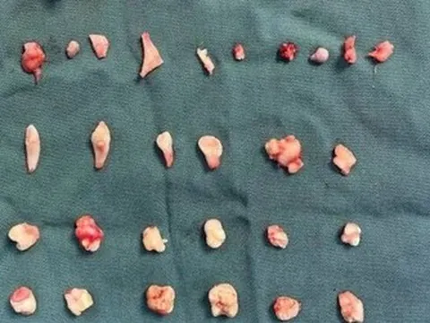 Cô gái đau bụng dữ dội, bác sĩ phát hiện ra bí mật bên trong