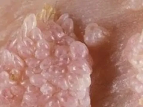 Người đàn ông gần 70 tuổi mắc sùi mào gà sau quan hệ không an toàn